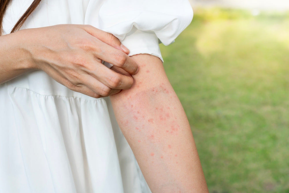 Common Skin Rashes in Summer: Prevention & Treatment Tips